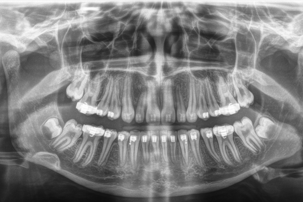Ağız içi (intraoral) radyografiler