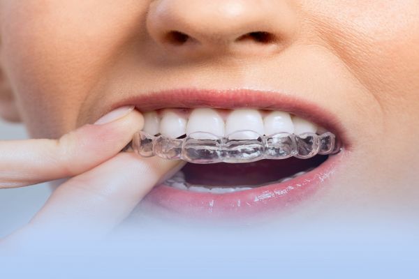 Şeffaf Plak ( Telsiz Ortodonti ) Tedavisi Nedir ?